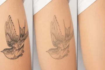 best Tattoo Removal