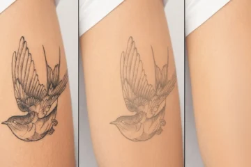 Tattoo Removal