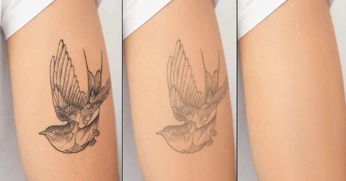 Tattoo Removal